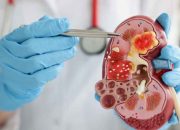 Kenali Ciri & Pencegahan Penyakit Ginjal Sebelum Terlambat