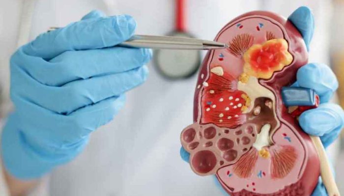 Kenali Ciri & Pencegahan Penyakit Ginjal Sebelum Terlambat