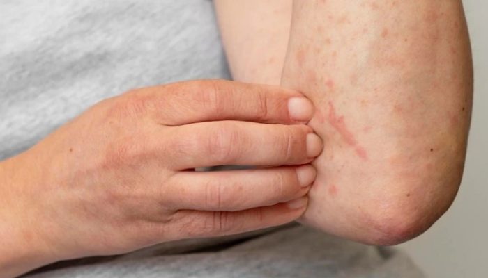 Kulit Gatal? Ini Tips Ampuh Biar Nggak Balik Lagi